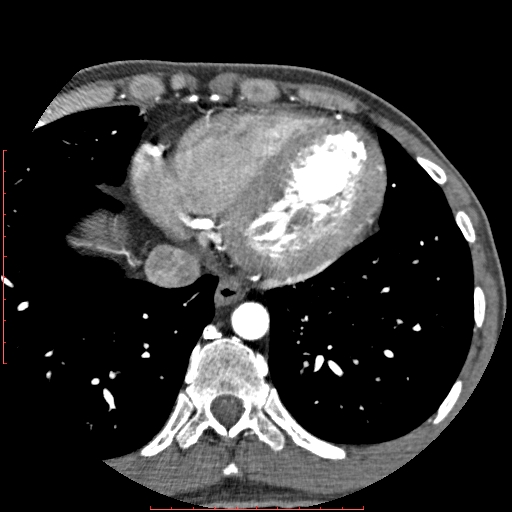 Anomalous left coronary artery from the pulmonary artery (ALCAPA) (Radiopaedia 70148-80181 A 299).jpg