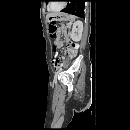 Anorectal carcinoma (Radiopaedia 44413-48064 C 79).jpg