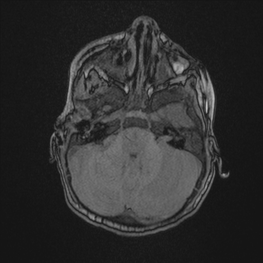 Anoxic brain injury (Radiopaedia 79165-92139 Axial MRA 53).jpg