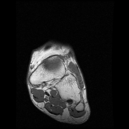 File:Anterior calcaneal process fracture (Radiopaedia 74654-85611 Coronal T1 1).jpg