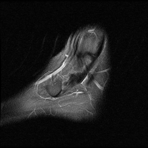 File:Anterior calcaneal process fracture (Radiopaedia 74654-85611 Sagittal PD fat sat 2).jpg