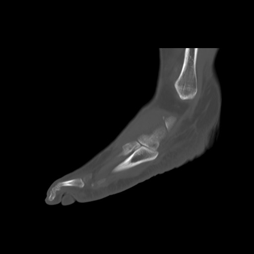 File:Anterior calcaneal process fracture (Radiopaedia 82590-96762 Sagittal bone window 22).jpg