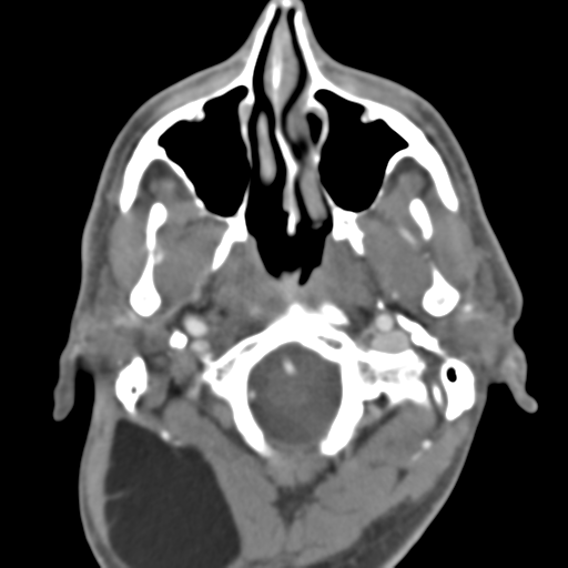 Anterior cerebral artery territory infarct (Radiopaedia 39327-41581 B 51).png