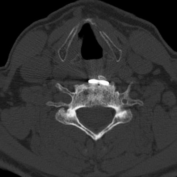Anterior cervical postdiscectomy arthrodesis (Radiopaedia 32678-33646 Axial bone window 50).jpg