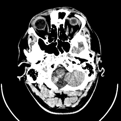 Anterior choroidal artery infarct (Radiopaedia 55106-61480 Axial non-contrast 4).jpg