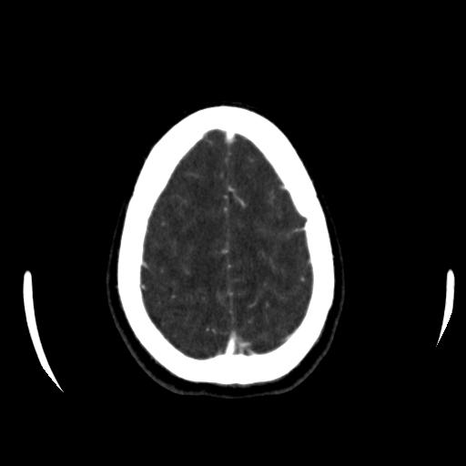 File:Anterior communicating artery aneurysm (Radiopaedia 16633-16335 A 38).jpg
