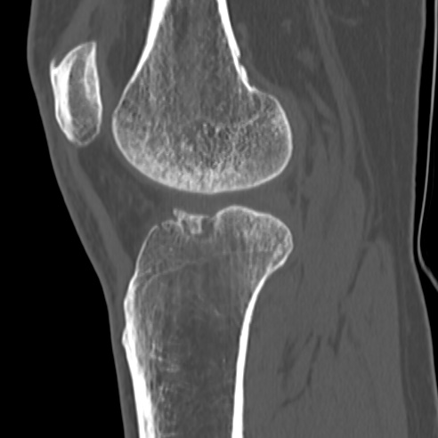 File:Anterior cruciate ligament avulsion fracture (Radiopaedia 58939-66194 Sagittal bone window 15).jpg
