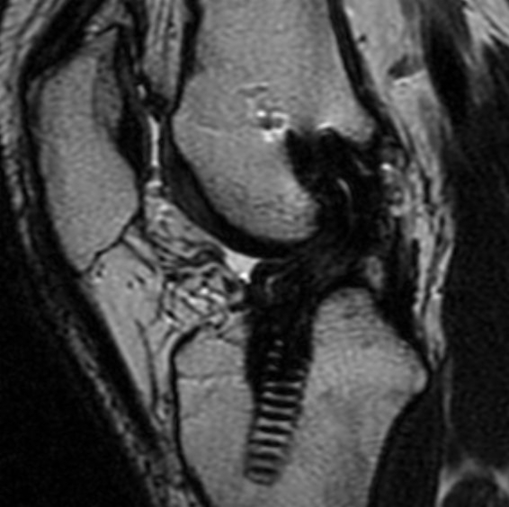 File:Anterior cruciate ligament graft roof impingement (Radiopaedia 15302).jpg