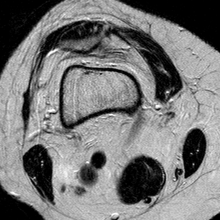 File:Anterior cruciate ligament mucoid degeneration (Radiopaedia 60853-68633 Axial T2 26).jpg