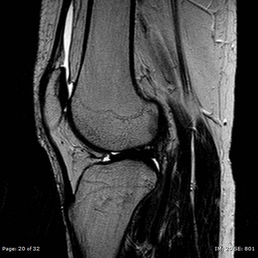 File:Anterior cruciate ligament tear (Radiopaedia 70783-80964 Sagittal T2 20).jpg
