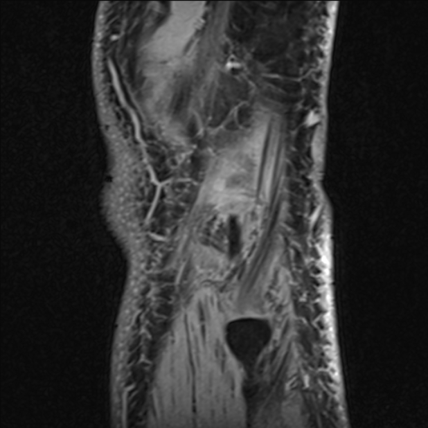 Anterior cruciate ligament tear - ramp lesion (Radiopaedia 71883-82322 Sagittal T1 vibe 14).jpg
