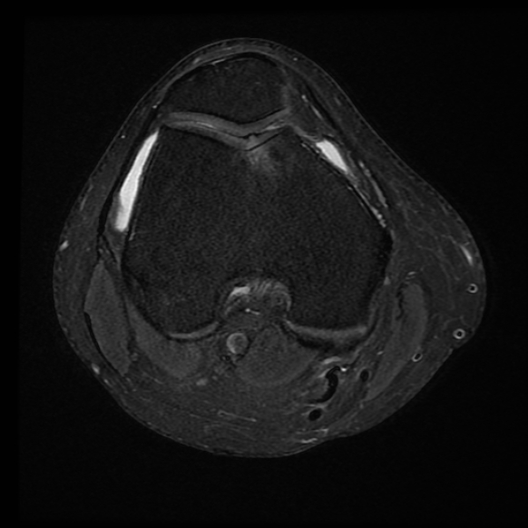 File:Anterior cruciate ligament tear with posteromedial corner injury, bucket-handle meniscal tear and chondral delamination (Radiopaedia 75501-86744 Axial PD fat sat 17).jpg