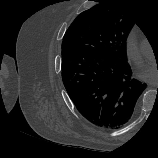 Anterior glenohumeral dislocation with Hill-Sachs lesion (Radiopaedia 62877-71249 Axial bone window 115).jpg