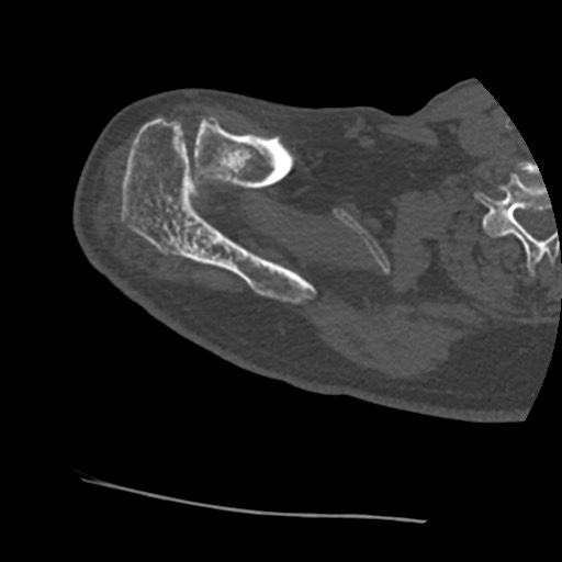 Anterior glenohumeral dislocation with Hill-Sachs lesion (Radiopaedia 62877-71249 Axial bone window 14).jpg