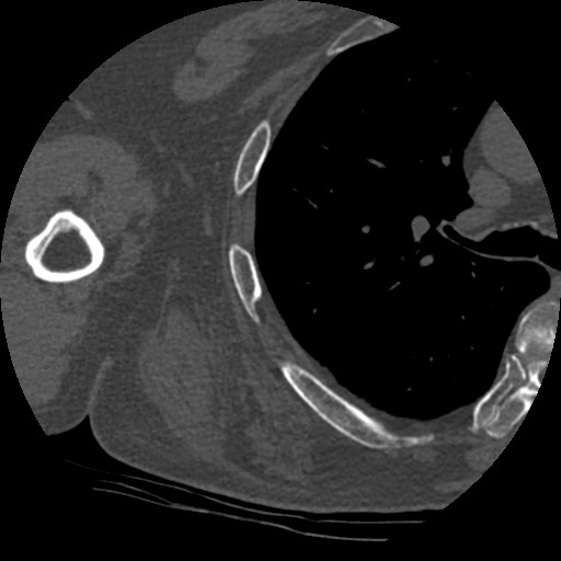 File:Anterior glenohumeral dislocation with Hill-Sachs lesion (Radiopaedia 62877-71249 Axial bone window 82).jpg