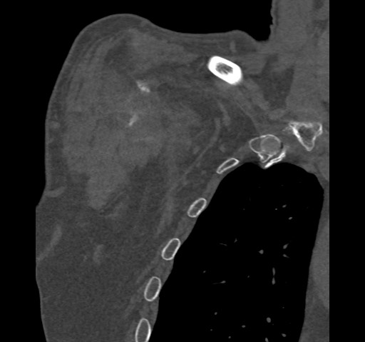 File:Anterior glenohumeral dislocation with Hill-Sachs lesion (Radiopaedia 62877-71249 Coronal bone window 8).jpg