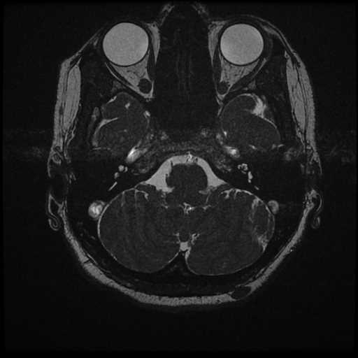Anterior inferior cerebellar artery vascular loop - type II (Radiopaedia 70991-81209 Axial 3D FIESTA 50).jpg