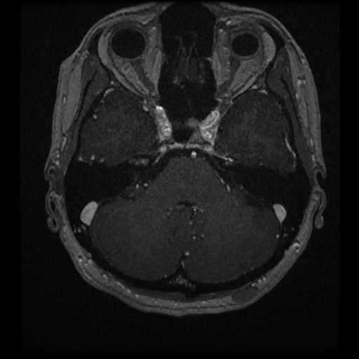 Anterior inferior cerebellar artery vascular loop - type II (Radiopaedia 70991-81209 Axial T1 C+ 42).jpg