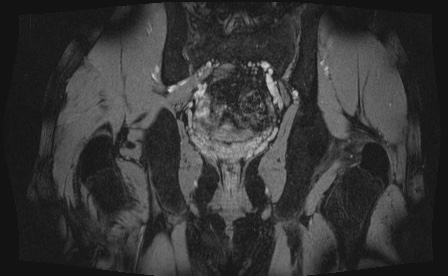 Anterior inferior iliac spine avulsion fracture (Radiopaedia 81312-95000 G 9).jpg