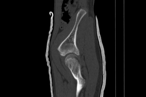 Anterior inferior iliac spine avulsion injury (Radiopaedia 88666-105376 Sagittal bone window 24).jpg