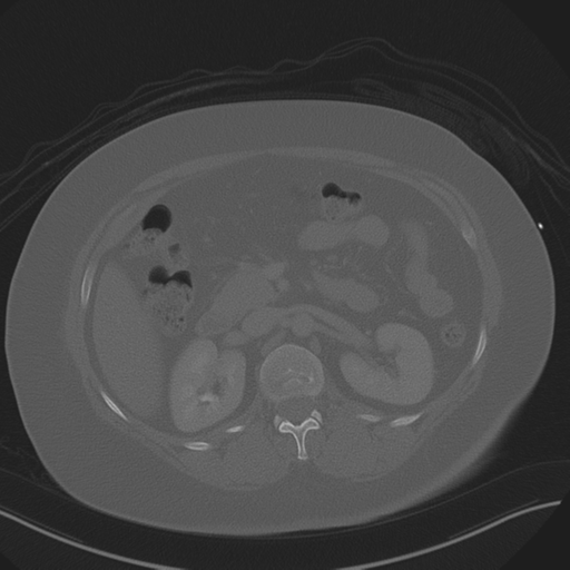 Anterior superior iliac spine avulsion fracture (Radiopaedia 44541-48244 Axial bone window 37).png