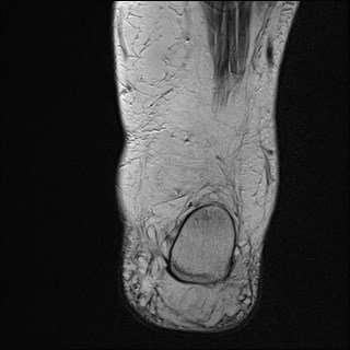 File:Anterior talofibular ligament injury - rupture with soft-tissue impingement (Radiopaedia 38765-40928 Coronal T2 6).jpg