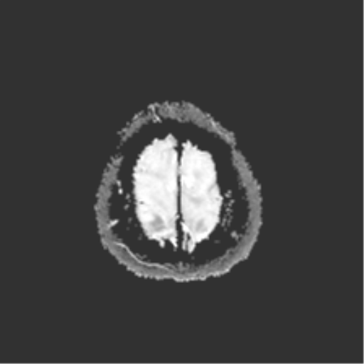 File:Anterior temporal lobe perivascular space (Radiopaedia 40946-43650 Axial ADC 27).png