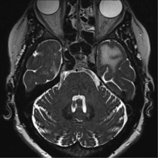 Anterior temporal pole cysts (Radiopaedia 46629-51102 Axial 18).png