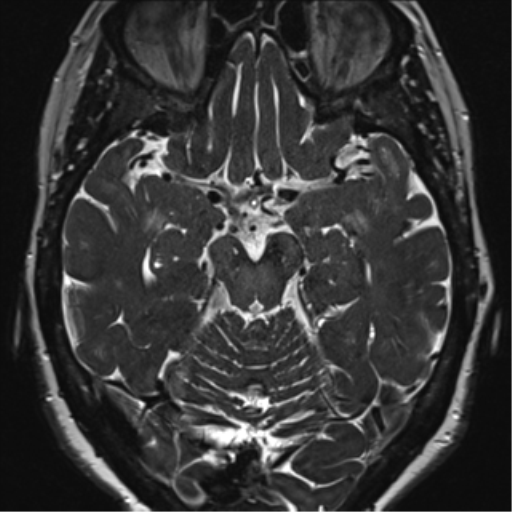 Anterior temporal pole cysts (Radiopaedia 46629-51102 Axial 46).png