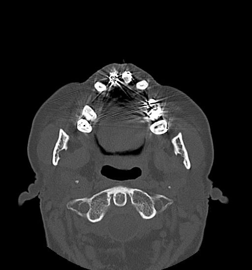 Anterior temporomandibular joint dislocation (Radiopaedia 59430-66784 Axial non-contrast 29).jpg