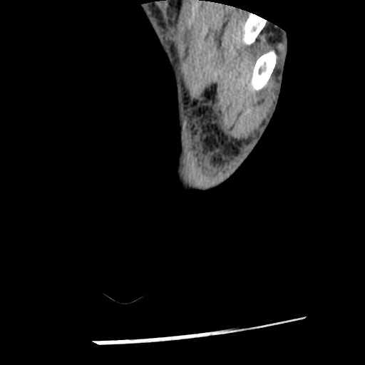 File:Anterior tibial artery false aneurysm (Radiopaedia 88984-105809 A 261).jpg