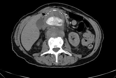 Anterior vertebral scalloping (abdominal aortic aneurysm) (Radiopaedia 66744-76067 F 36).jpg