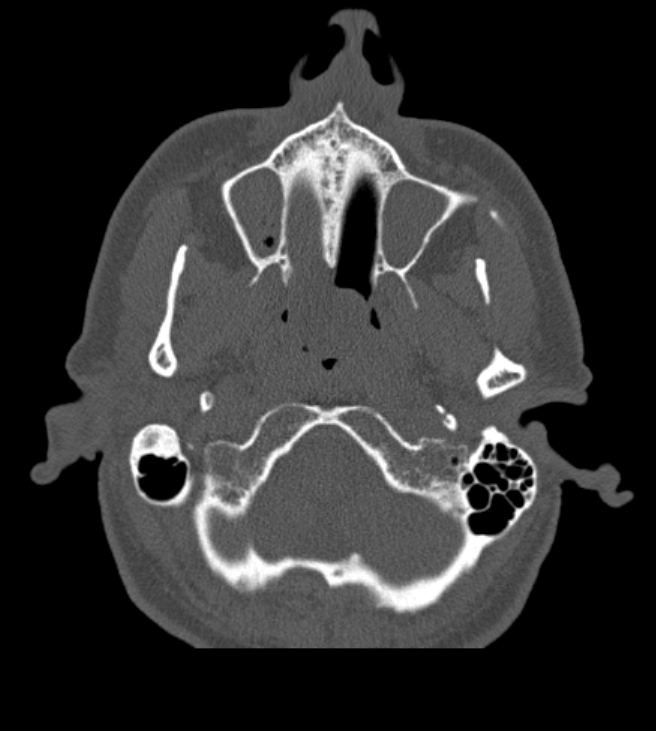 Antrochoanal polyp (Radiopaedia 79011-92169 Axial bone window 11).jpg