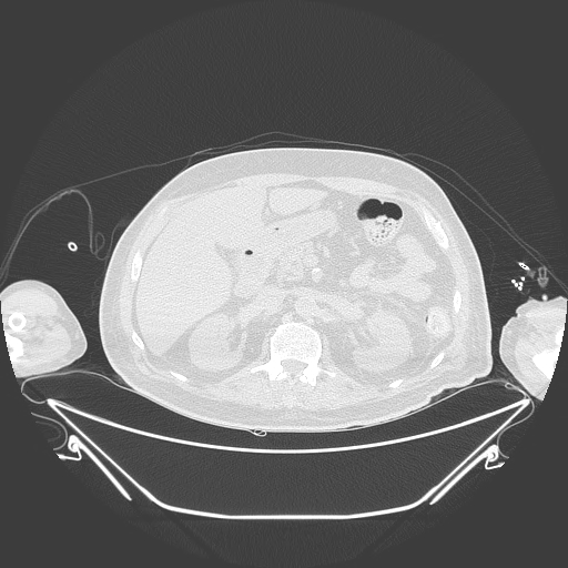 Aortic arch aneurysm (Radiopaedia 84109-99365 Axial lung window 316).jpg