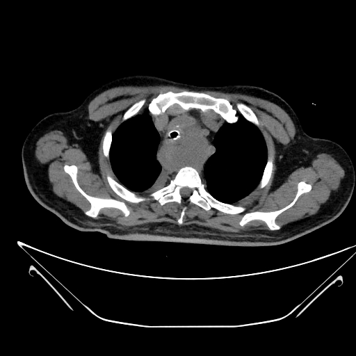 Aortic arch aneurysm (Radiopaedia 84109-99365 Axial non-contrast 59).jpg