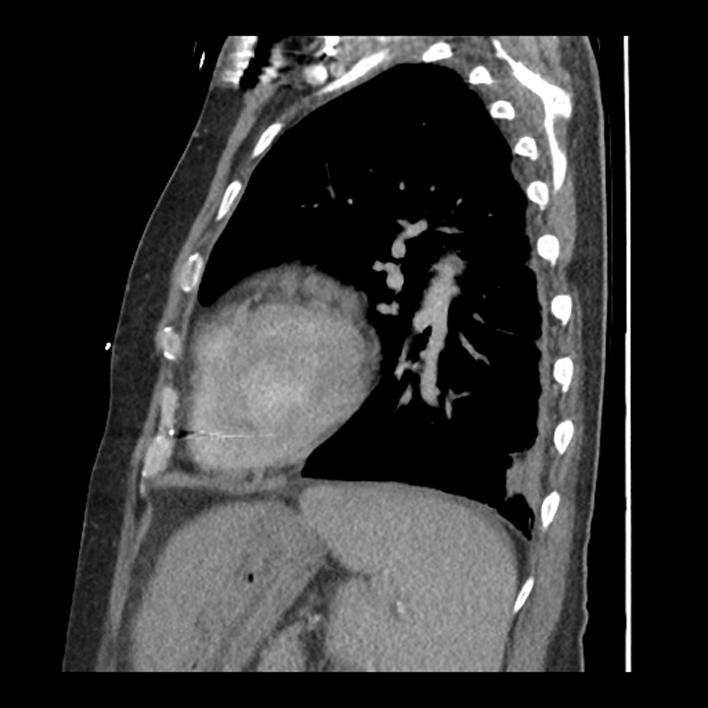 Aortic arch graft infection (FDG PET-CT) (Radiopaedia 71975-82437 C 50).jpg