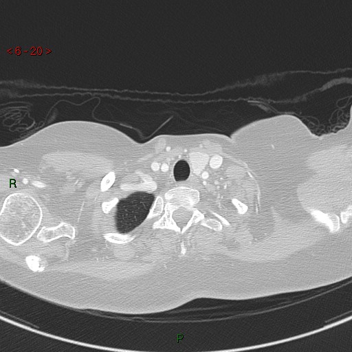 Aortic arch origin of left vertebral artery (Radiopaedia 51520-57286 Axial lung window 20).jpg