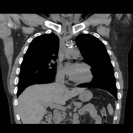 File:Aortic arch stent (Radiopaedia 30030-30595 Coronal non-contrast 6).jpg