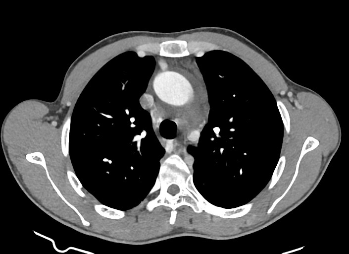 File:Aortic coarctation with aneurysm (Radiopaedia 74818-85828 A 138).jpg