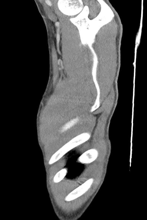 Aortic coarctation with aneurysm (Radiopaedia 74818-85828 B 15).jpg