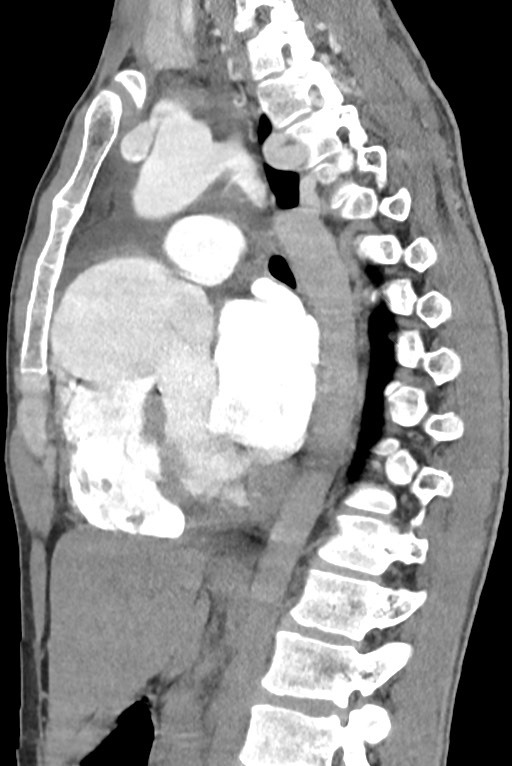 Aortic coarctation with aneurysm (Radiopaedia 74818-85828 B 90).jpg