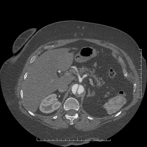 File:Aortic dissection- Stanford A (Radiopaedia 35729-37268 B 45).jpg
