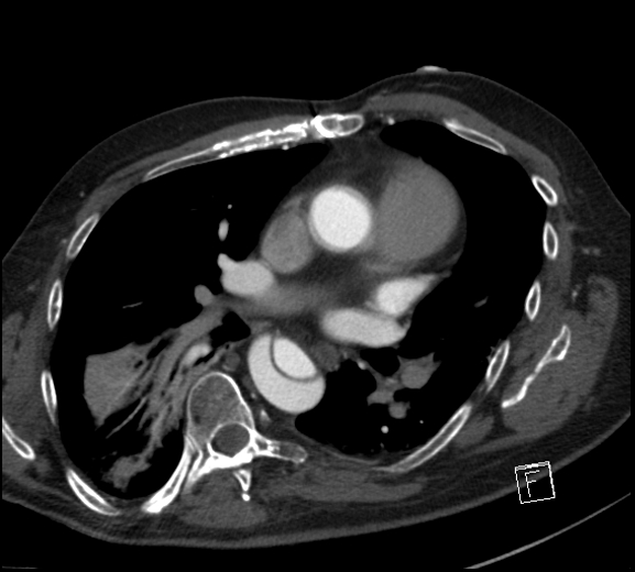 File:Aortic dissection (CTPA) (Radiopaedia 75506-86750 A 49).jpg