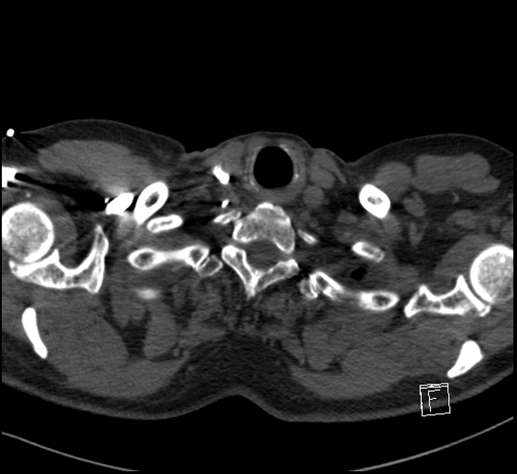 File:Aortic dissection (CTPA) (Radiopaedia 75506-86751 Axial C+ CTPA 6).jpg