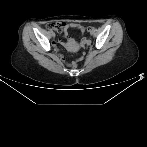 File:Aortic dissection (Radiopaedia 25350-25604 B 69).jpg