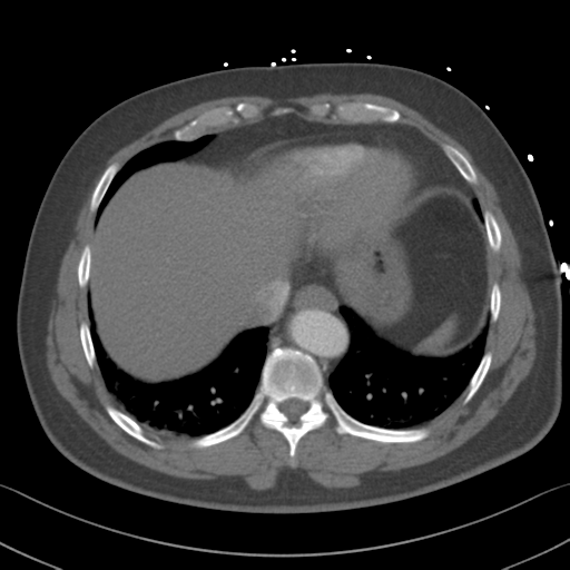 File:Aortic dissection (Radiopaedia 50763-56234 A 59).png