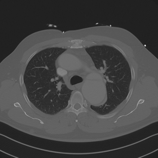 Aortic dissection (Radiopaedia 50763-56234 Axial bone window 41).png