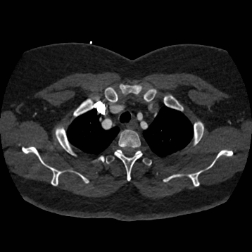 Aortic dissection (Radiopaedia 57969-64959 A 57).jpg