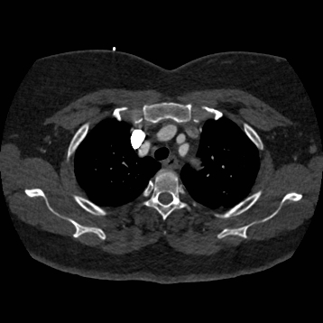 Aortic dissection (Radiopaedia 57969-64959 A 72).jpg