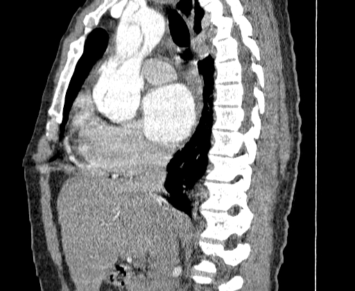 Aortic dissection - Stanford A -DeBakey I (Radiopaedia 28339-28587 C 18).jpg